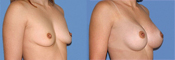 Breast augmentation photos