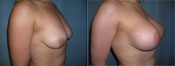 breast lift surgery photos