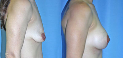 Breast Lift Surgery before and after photos