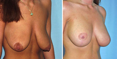 Breast Lift Surgery before and after photos