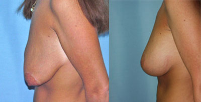 Breast Lift Surgery before and after photos
