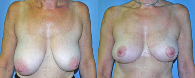 Breast Lift Surgery before and after photos