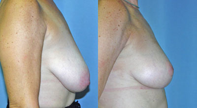 Breast Lift Surgery before and after photos