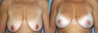 Breast lift photos