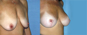 breast lift surgery photos