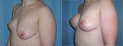breast lift surgery photos