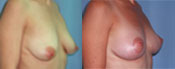 breast lift surgery photos
