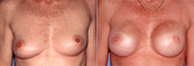 Breast Reconstruction Photos