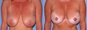 Breast Reconstruction Photos