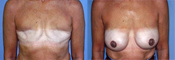 Breast Reconstruction Photos