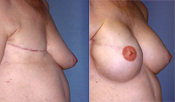 Breast Reconstruction Photos