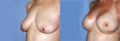 Breast Reconstruction Photos