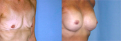 Breast Reconstruction Photos