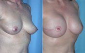 Breast Reconstruction Photos