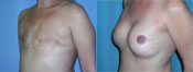 Breast Reconstruction Photos