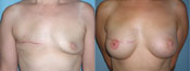 Breast Reconstruction Photos
