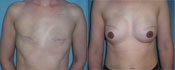 Breast Reconstruction Photos