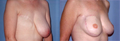 Breast Reconstruction Photos