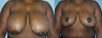 Breast Reduction surgery