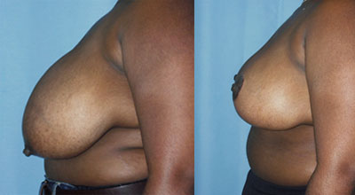 Breast Reduction surgery