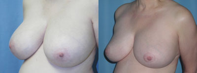 Breast Reduction surgery