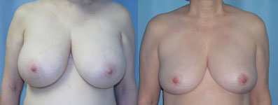 Breast Reduction surgery