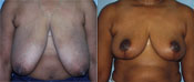 breast reduction surgery photos