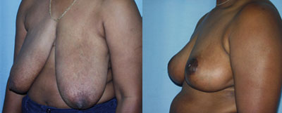 Breast Reduction surgery