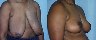 Breast Reduction surgery