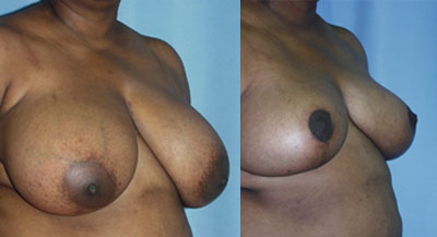 Breast Reduction surgery