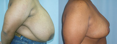 Breast Reduction surgery