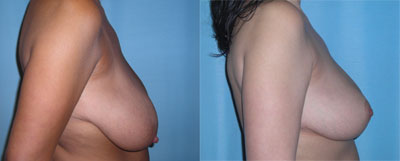Breast Reduction surgery
