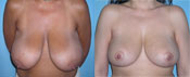 breast reduction surgery photos