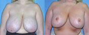 breast reduction surgery photos