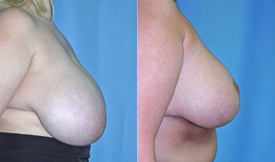 Breast Reduction surgery