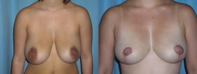 breast lift surgery photos