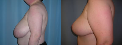 breast reduction surgery photos