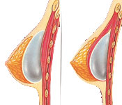 Breast lift diagram
