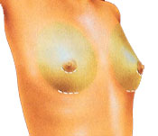 Breast lift diagram