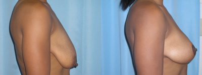 breast lift
